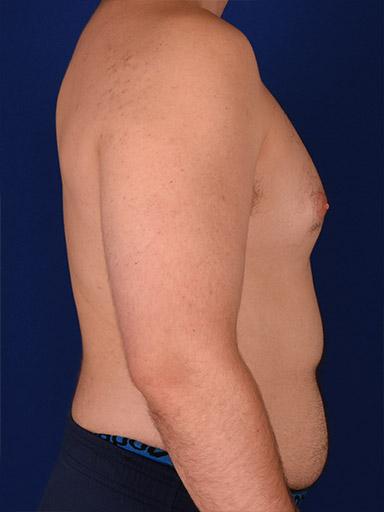 Gynecomastia Surgery after at Shapiro Plastic Surgery in Scottsdale, AZ