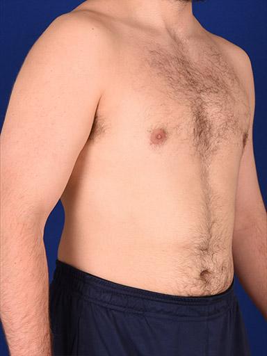 Gynecomastia Surgery before at Shapiro Plastic Surgery in Scottsdale, AZ