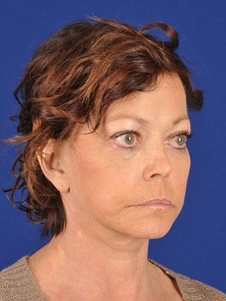 Fat Transfer after at Shapiro Plastic Surgery in Scottsdale, AZ