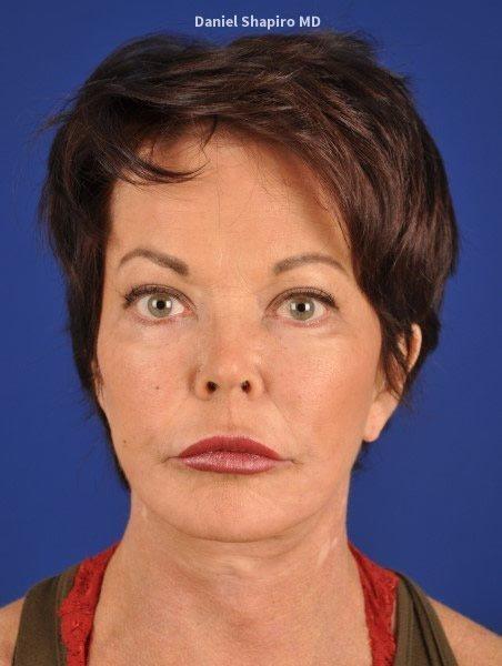Fat Transfer before at Shapiro Plastic Surgery in Scottsdale, AZ