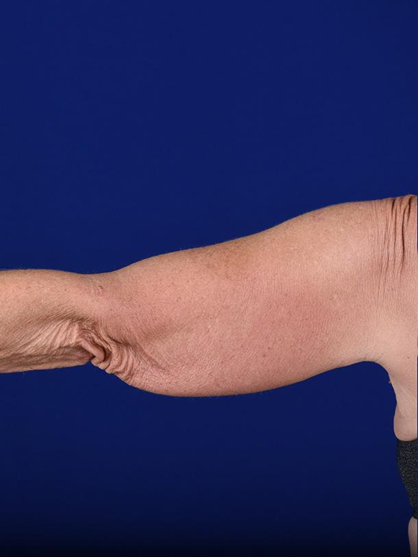 Arm Lift after at Shapiro Plastic Surgery in Scottsdale, AZ