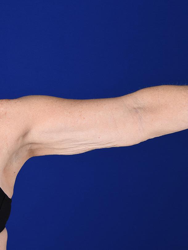 Arm Lift before at Shapiro Plastic Surgery in Scottsdale, AZ