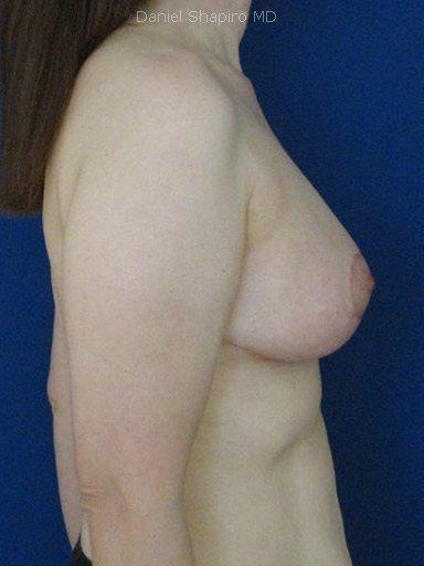 Breast Reduction before at Shapiro Plastic Surgery in Scottsdale, AZ