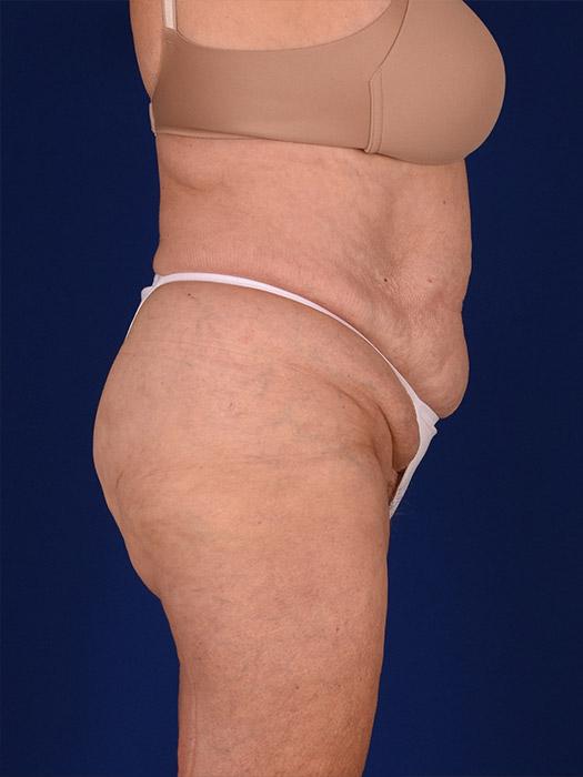 Shapiro Plastic Surgery tummy tuck after — Scottsdale, AZ