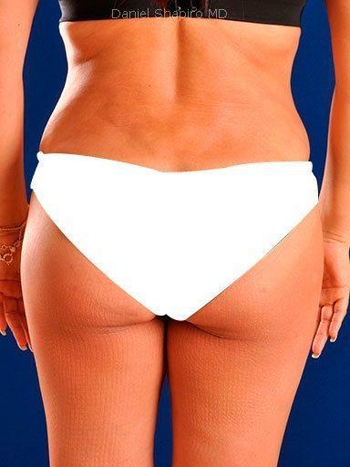Brazilian Butt Lift before at Shapiro Plastic Surgery in Scottsdale, AZ