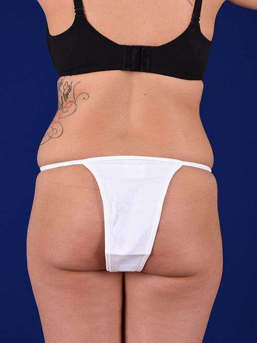 Shapiro Plastic Surgery bbl after — Scottsdale, AZ