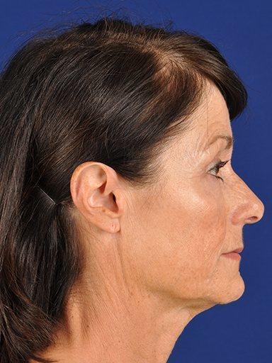 Shapiro Plastic Surgery facelift after — Scottsdale, AZ