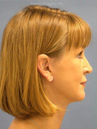 Chin Implant before at Shapiro Plastic Surgery in Scottsdale, AZ