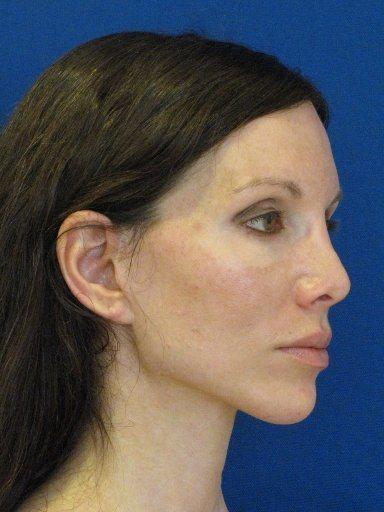 Shapiro Plastic Surgery fat transfer after — Scottsdale, AZ