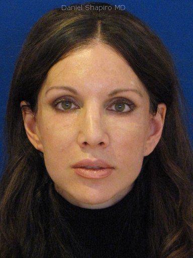 Fat Transfer before at Shapiro Plastic Surgery in Scottsdale, AZ