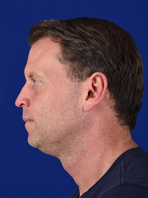 Shapiro Plastic Surgery rhinoplasty after — Scottsdale, AZ