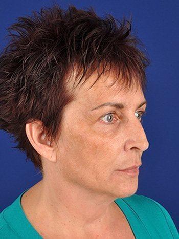 Shapiro Plastic Surgery fat transfer after — Scottsdale, AZ