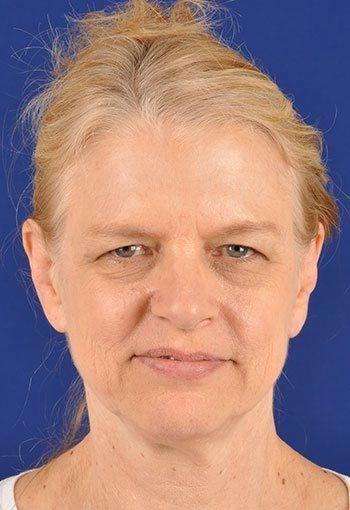 Shapiro Plastic Surgery blepharoplasty after — Scottsdale, AZ