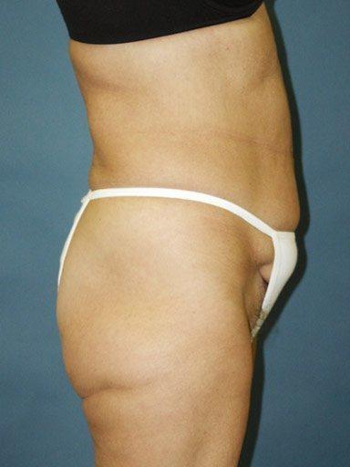 Shapiro Plastic Surgery liposuction after — Scottsdale, AZ
