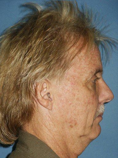 Shapiro Plastic Surgery rhinoplasty after — Scottsdale, AZ