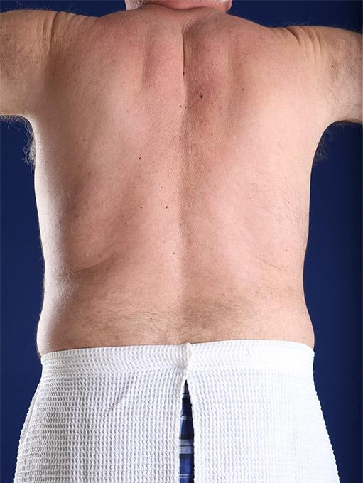 Liposuction after at Shapiro Plastic Surgery in Scottsdale, AZ