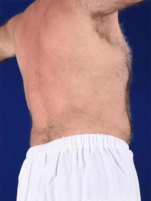 Liposuction before at Shapiro Plastic Surgery in Scottsdale, AZ
