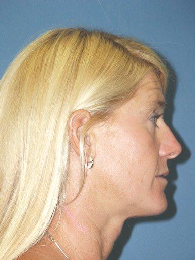 Brow Lift after at Shapiro Plastic Surgery in Scottsdale, AZ