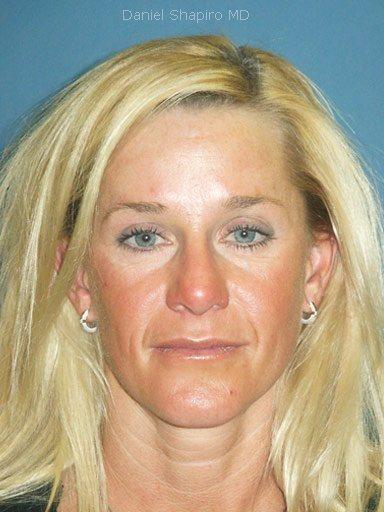 Brow Lift before at Shapiro Plastic Surgery in Scottsdale, AZ