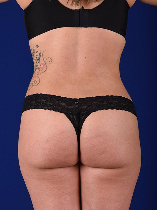 Liquid BBL before at Shapiro Plastic Surgery in Scottsdale, AZ