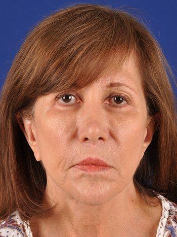 Fat Transfer after at Shapiro Plastic Surgery in Scottsdale, AZ