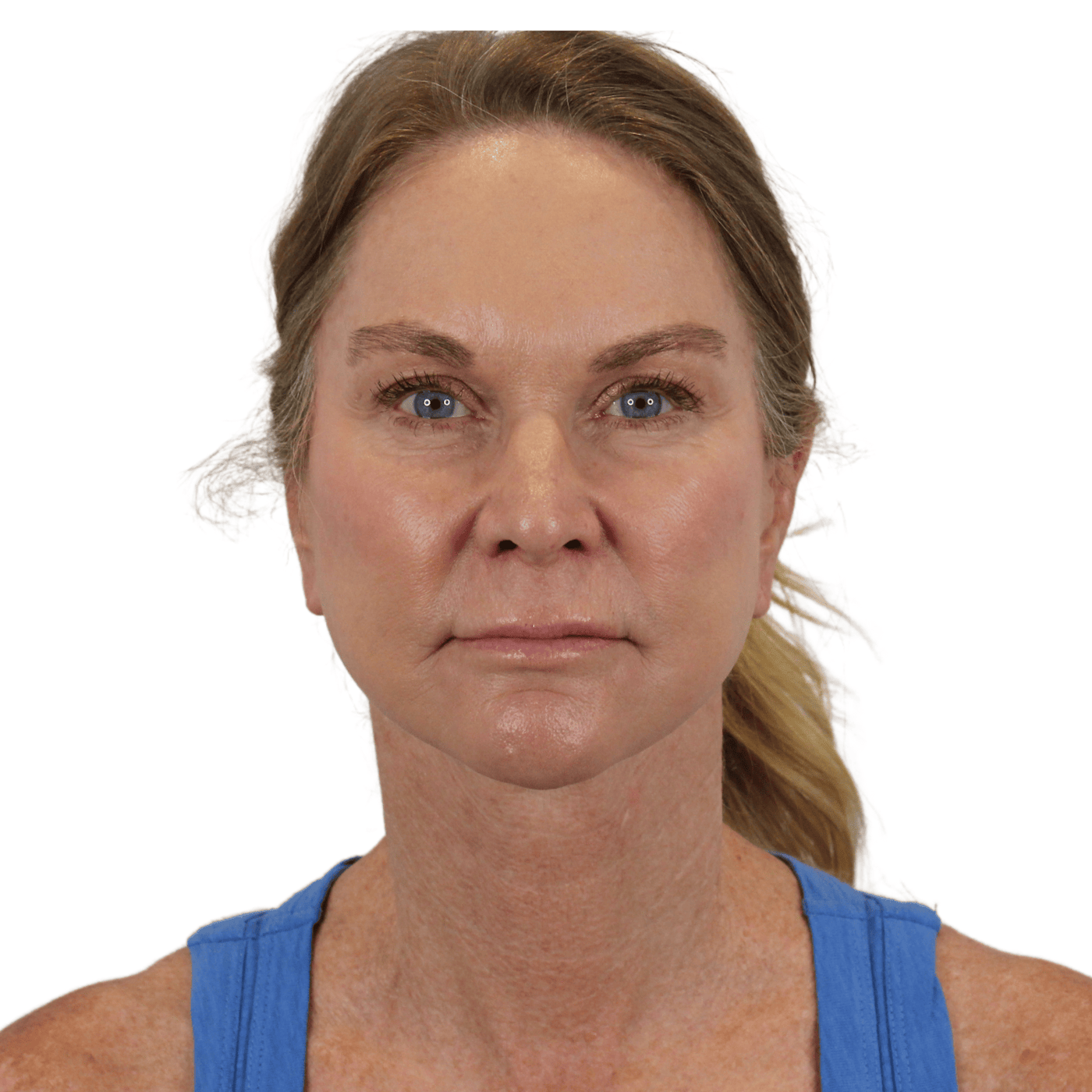Admire Plastic Surgery facelift after — Gilbert, AZ