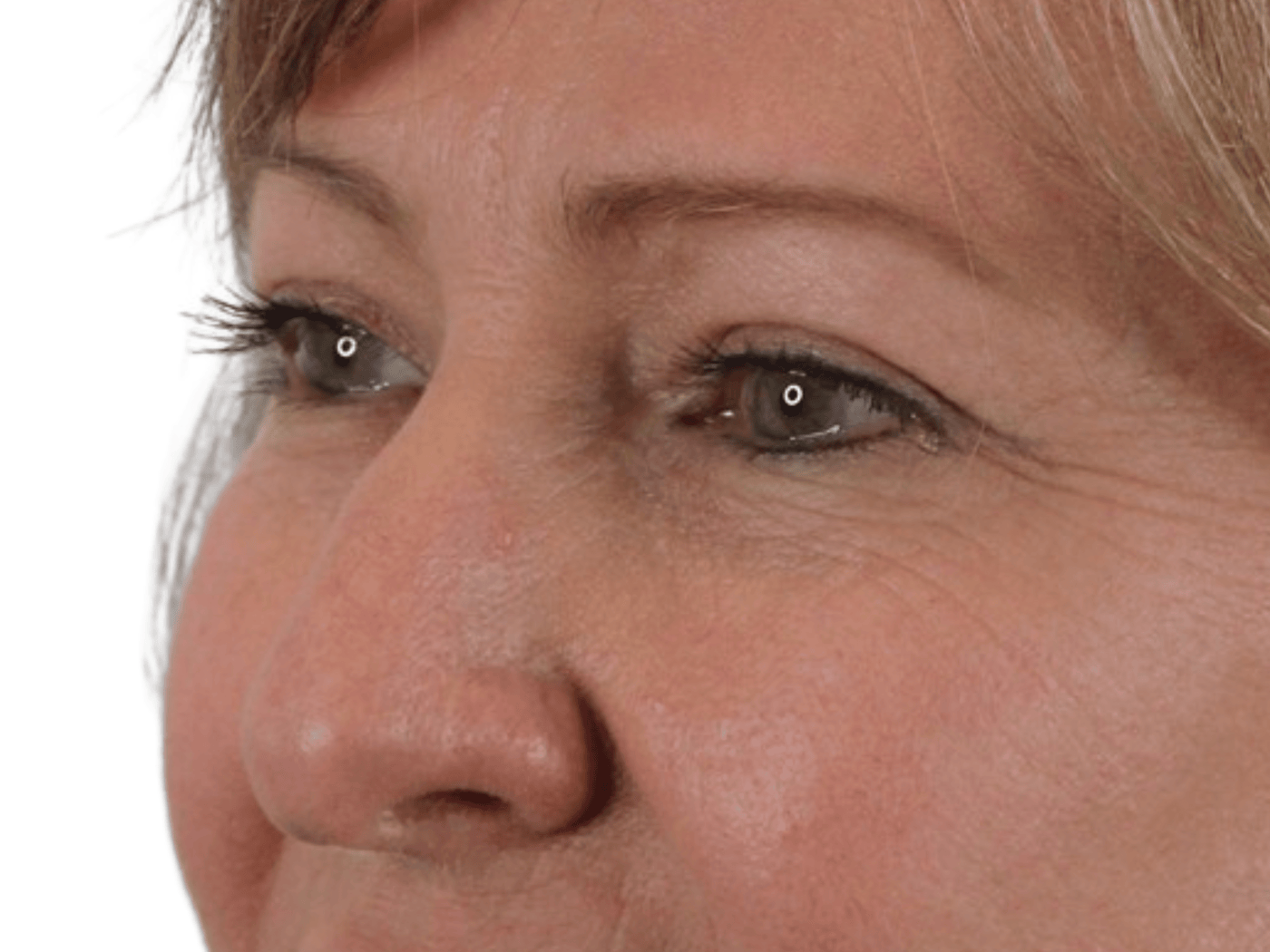 Admire Plastic Surgery blepharoplasty after — Gilbert, AZ