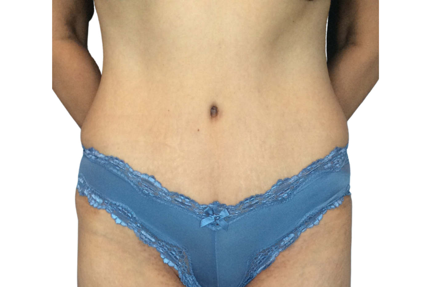 Admire Plastic Surgery tummy tuck after — Gilbert, AZ