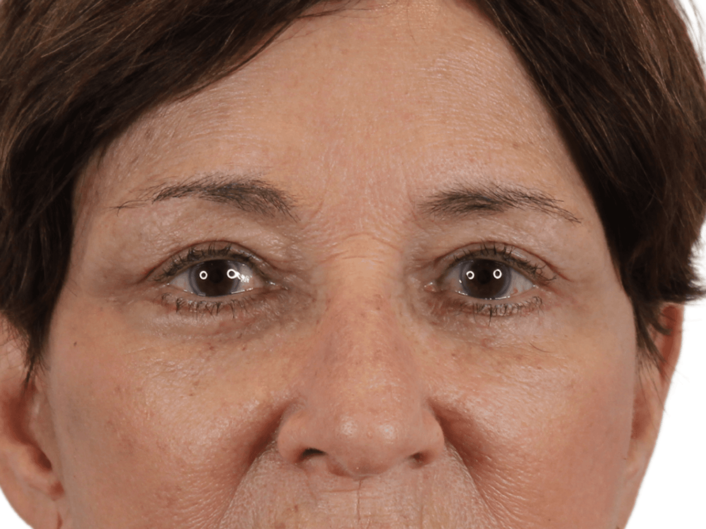 Admire Plastic Surgery blepharoplasty after — Gilbert, AZ
