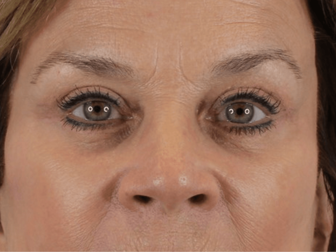 Admire Plastic Surgery blepharoplasty after — Gilbert, AZ