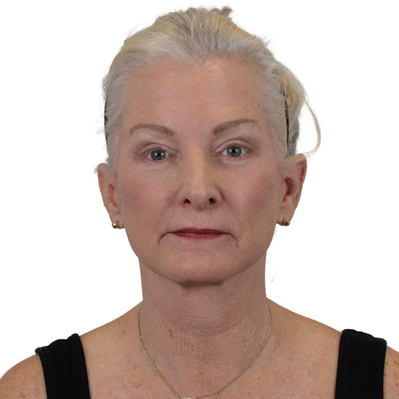 Admire Plastic Surgery facelift after — Gilbert, AZ