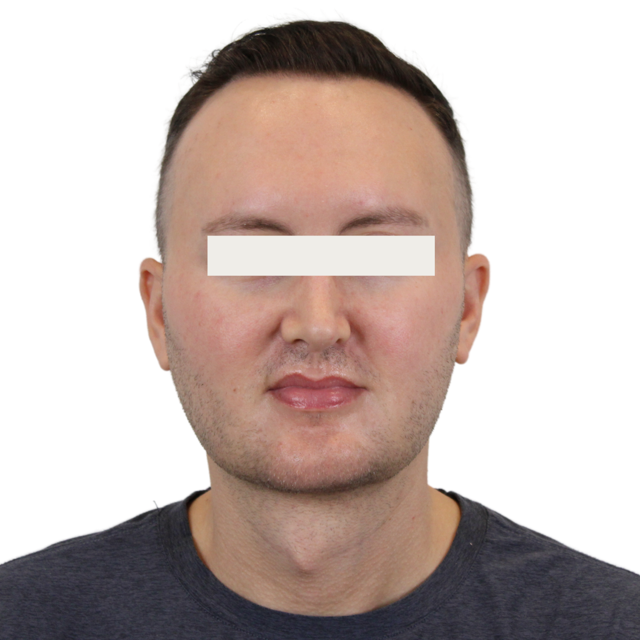 Neck Lift after at Admire Plastic Surgery in Gilbert, AZ