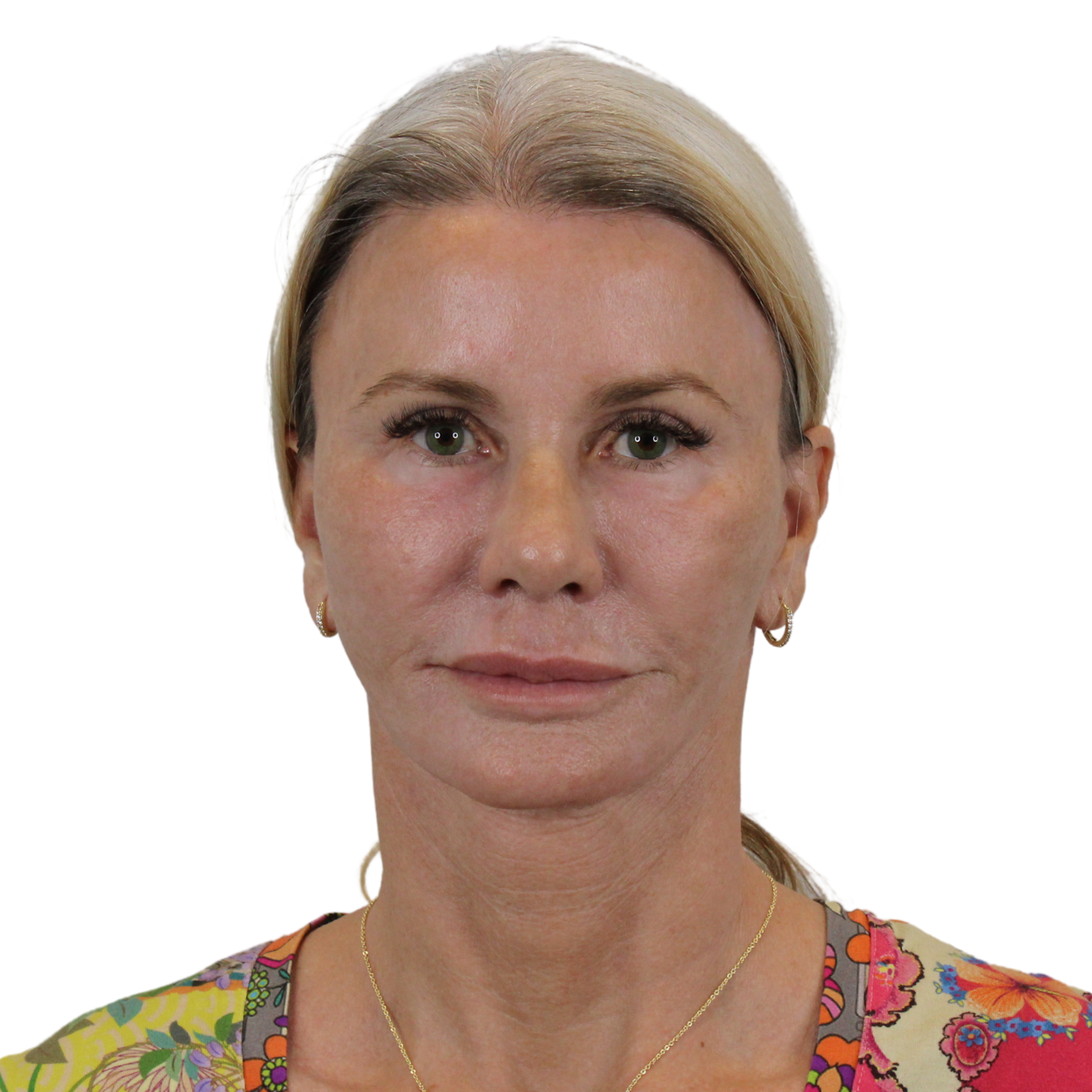Admire Plastic Surgery facelift after — Gilbert, AZ