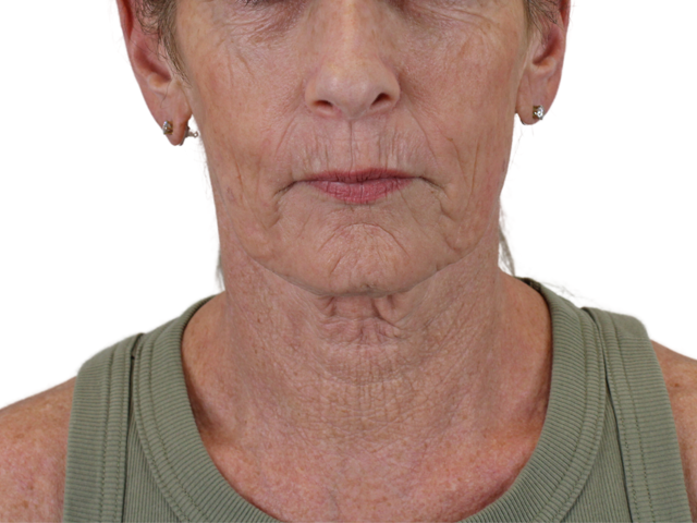 Chin Implant before at Admire Plastic Surgery in Gilbert, AZ
