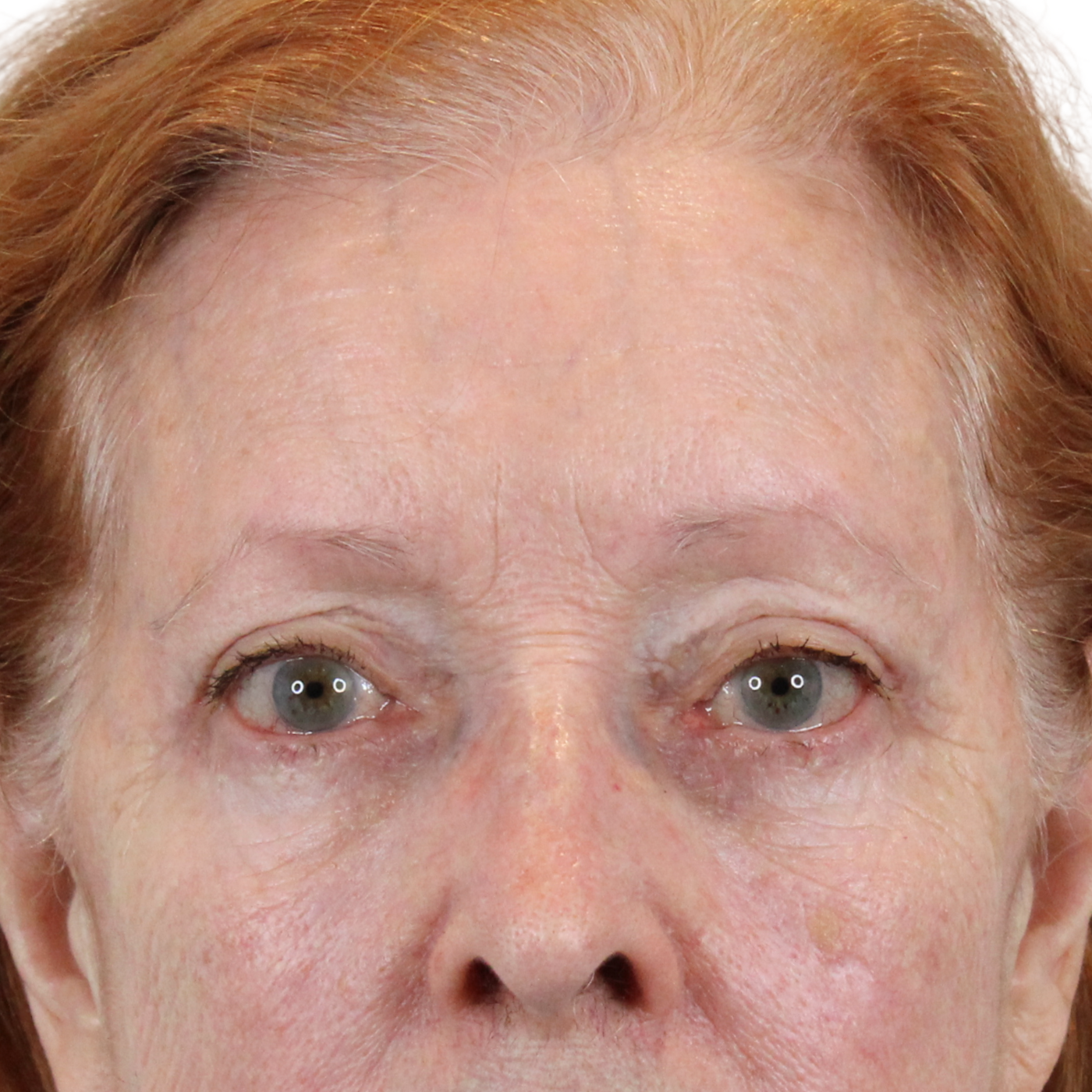 Admire Plastic Surgery blepharoplasty after — Gilbert, AZ