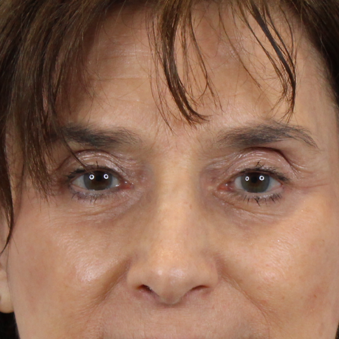 Admire Plastic Surgery blepharoplasty after — Gilbert, AZ