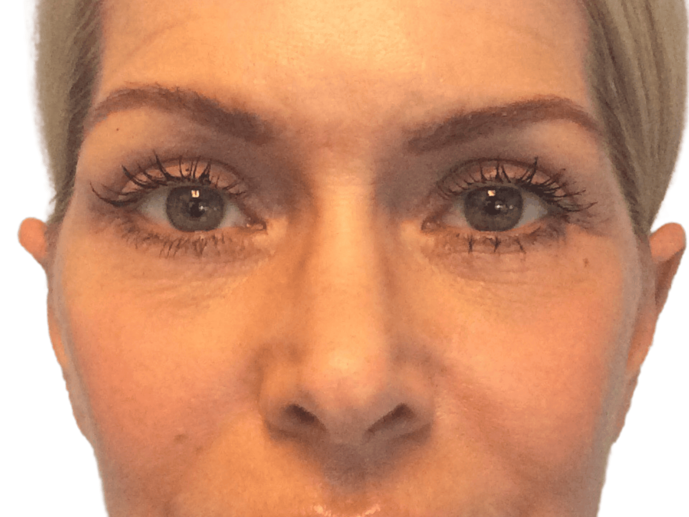 Admire Plastic Surgery blepharoplasty after — Gilbert, AZ