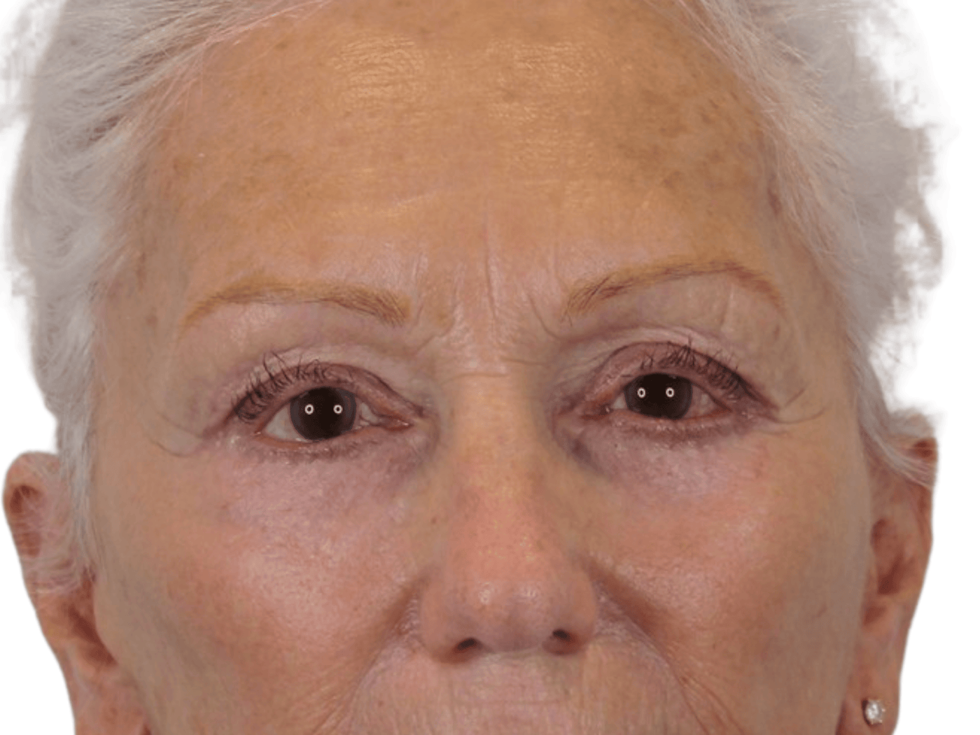 Admire Plastic Surgery blepharoplasty after — Gilbert, AZ