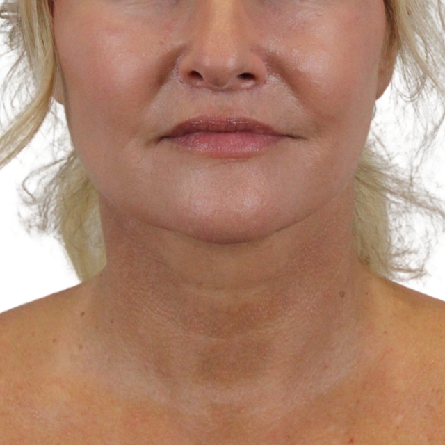Chin Implant after at Admire Plastic Surgery in Gilbert, AZ