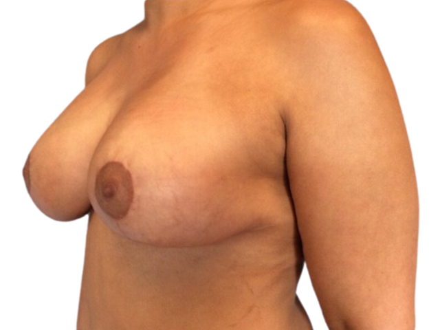 Breast Lift after at Admire Plastic Surgery in Gilbert, AZ