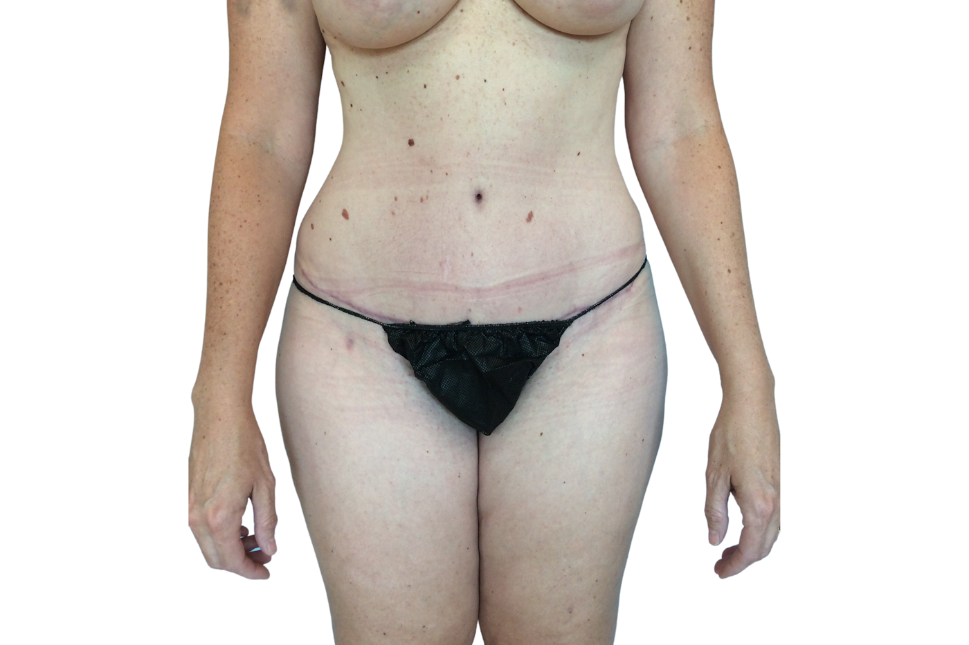 Admire Plastic Surgery tummy tuck after — Gilbert, AZ