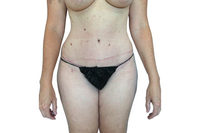 Mini Tummy Tuck after at Admire Plastic Surgery in Gilbert, AZ