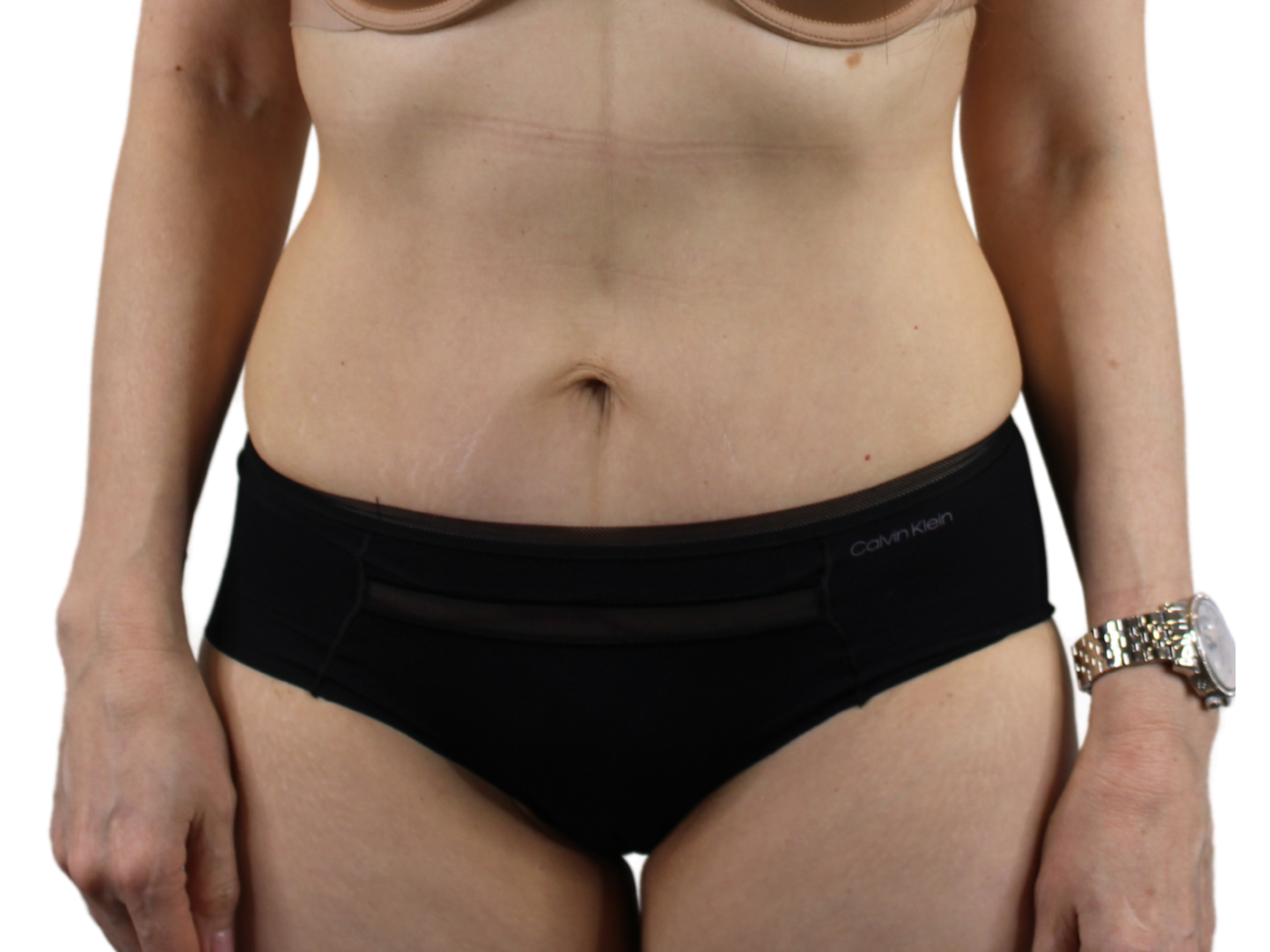 Admire Plastic Surgery tummy tuck after — Gilbert, AZ