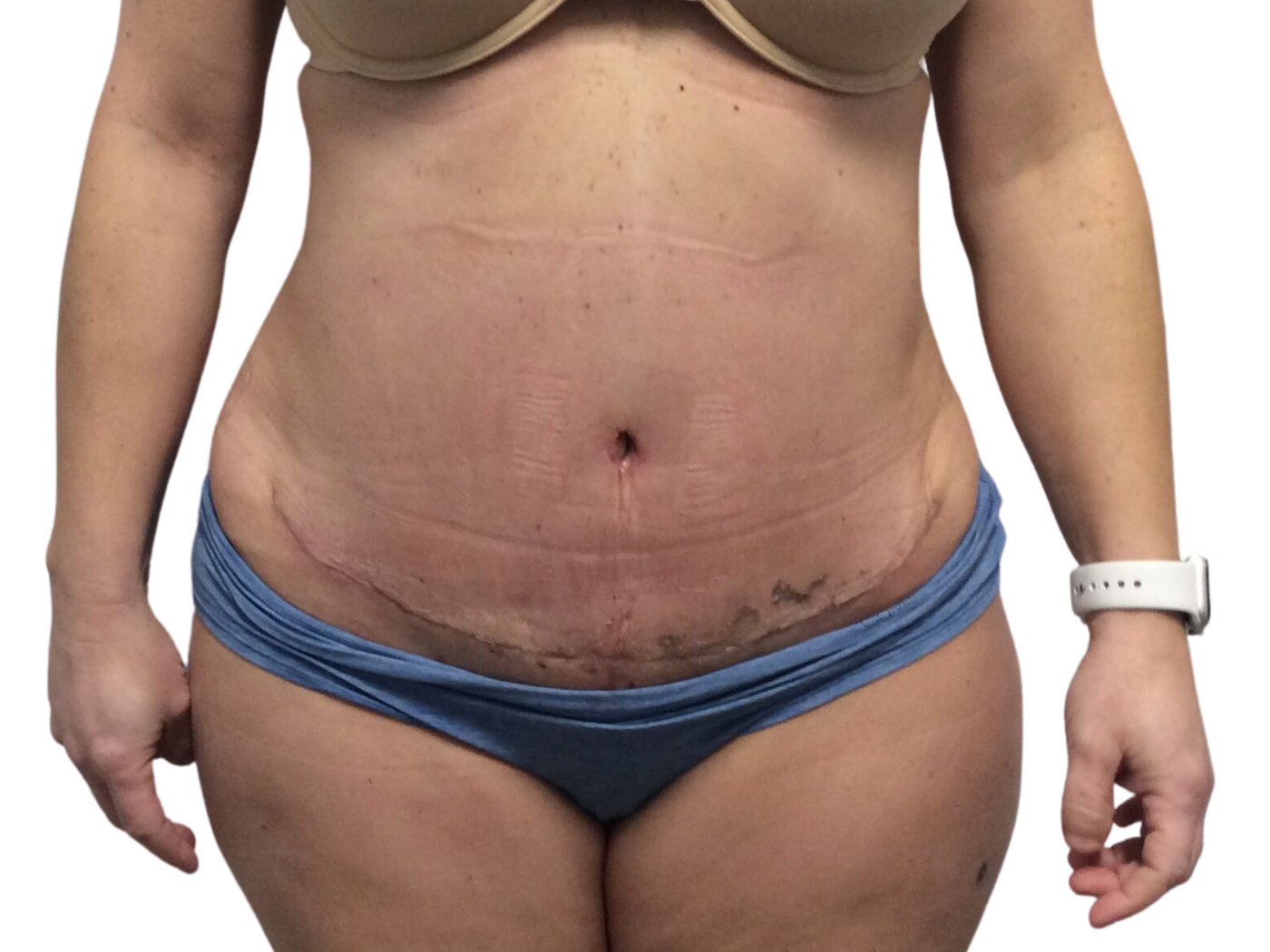 Admire Plastic Surgery tummy tuck after — Gilbert, AZ