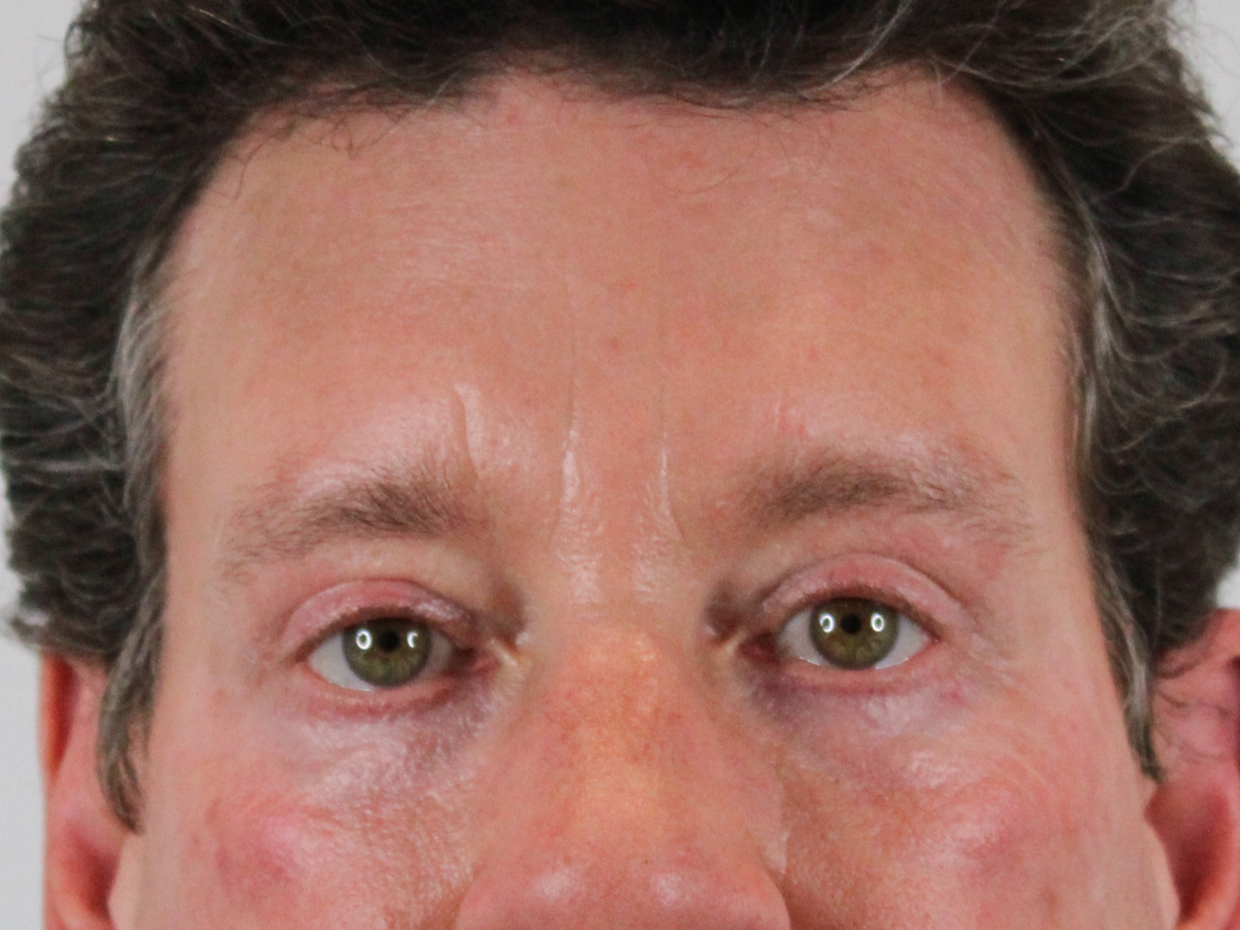 Admire Plastic Surgery blepharoplasty after — Gilbert, AZ