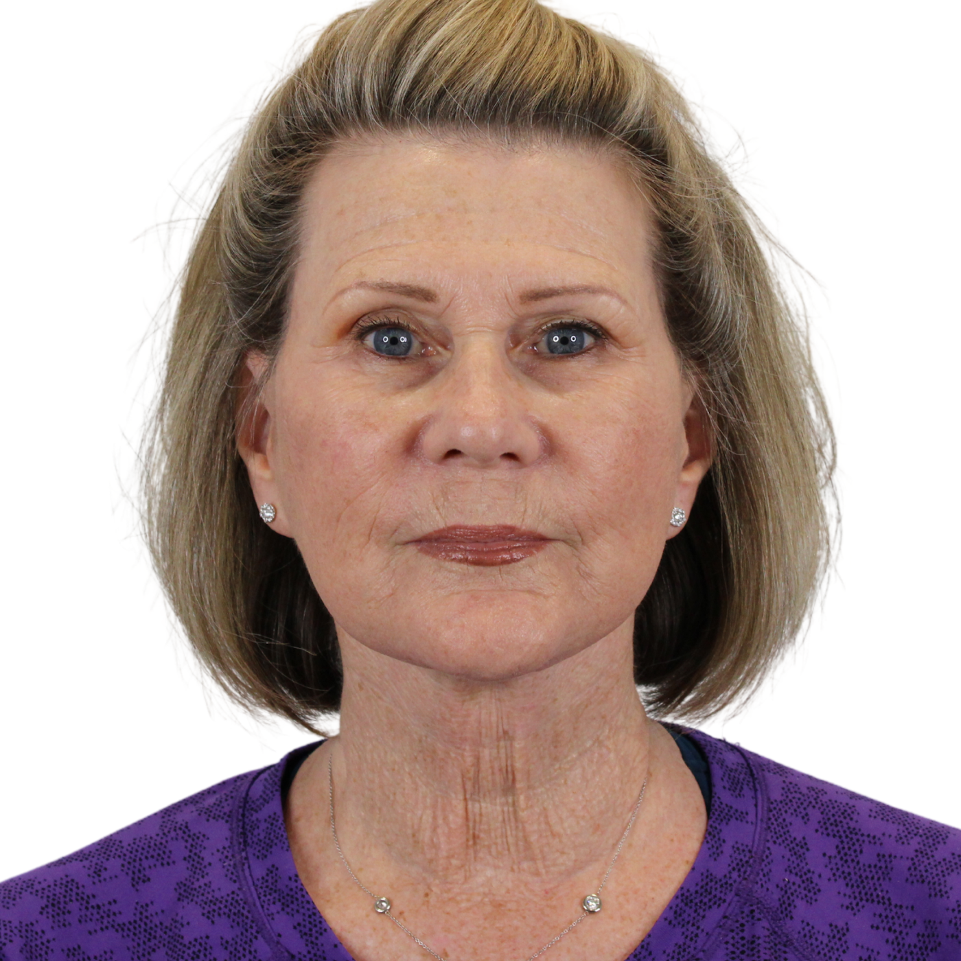 Admire Plastic Surgery facelift after — Gilbert, AZ