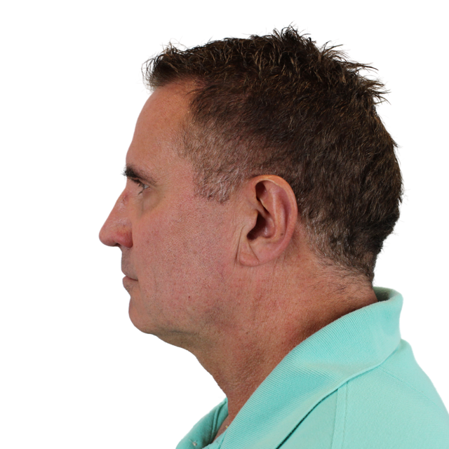 Functional Rhinoplasty before at Admire Plastic Surgery in Gilbert, AZ