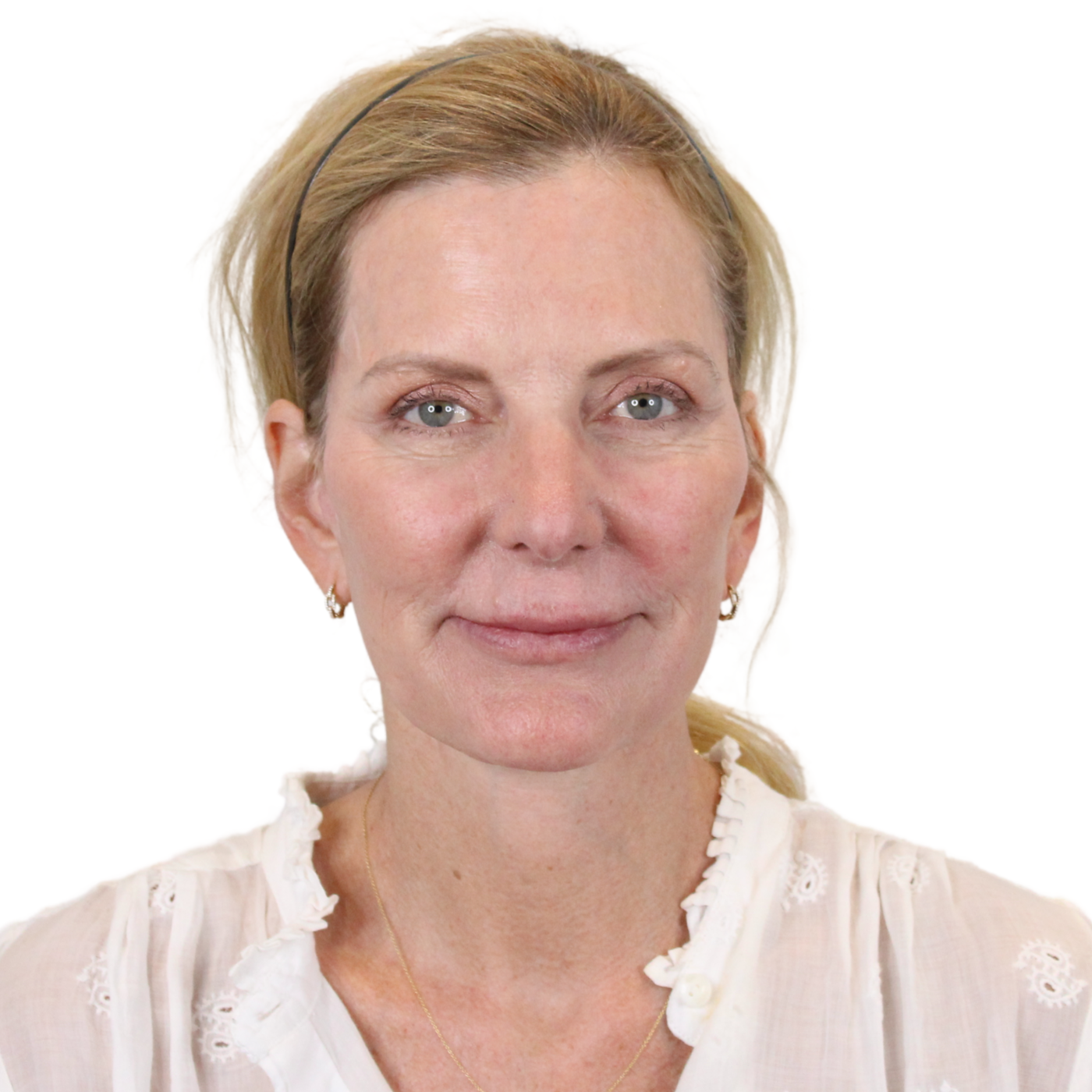 Admire Plastic Surgery facelift after — Gilbert, AZ