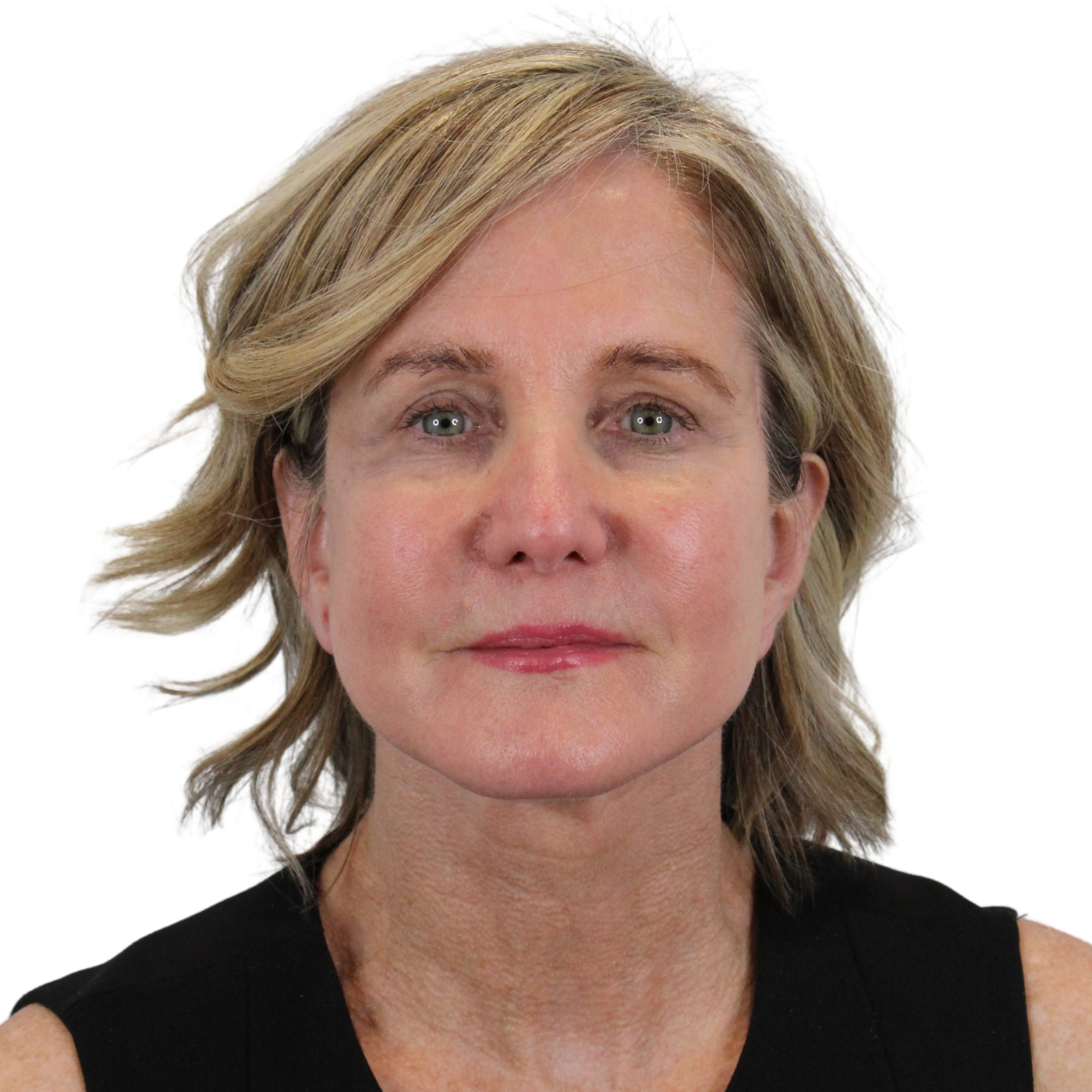 Admire Plastic Surgery facelift after — Gilbert, AZ