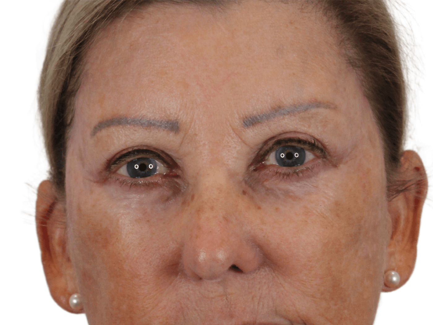 Admire Plastic Surgery blepharoplasty after — Gilbert, AZ
